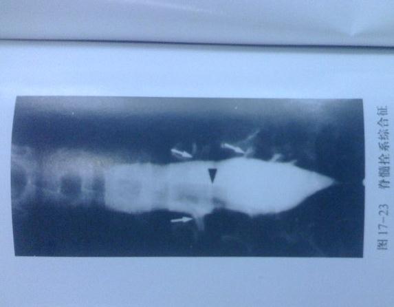 脊髓栓系综合征手术后复查,脊髓栓系手术术后复查表现