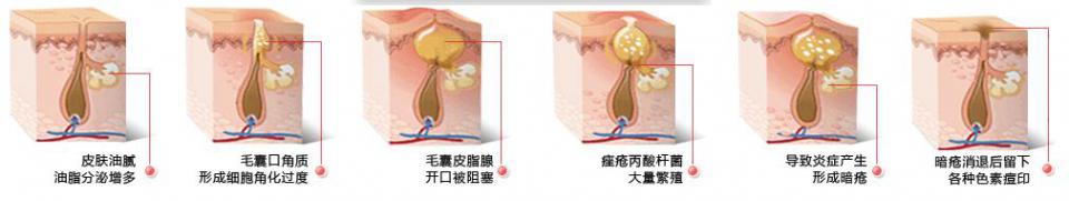 有什么方法祛痘有效最快,如何祛痘痘最有效的方法教给你