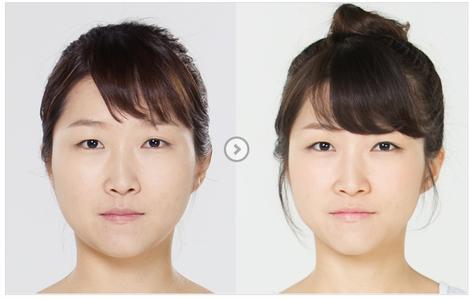 只打一次瘦脸针后咬肌能恢复多少,注射瘦脸针来瘦咬肌可以维持多久