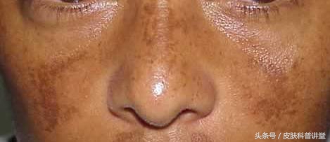 什么原因会长褐青斑,褐斑越来越多是什么原因