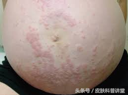 妊娠期瘙痒症,妊娠期特发性痒疹