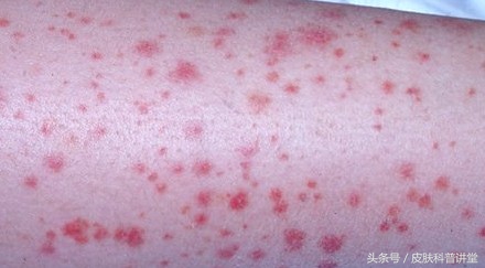 双小腿起红点不痛不痒是怎么回事,双小腿对称起红疹子痒是什么病