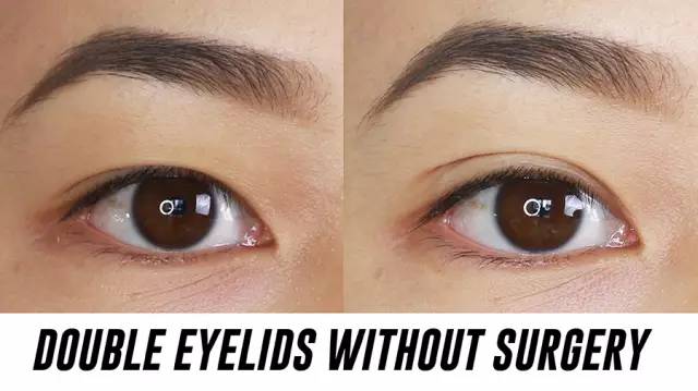 不开刀单眼皮怎么变双眼皮,内双不动刀怎么能变双眼皮