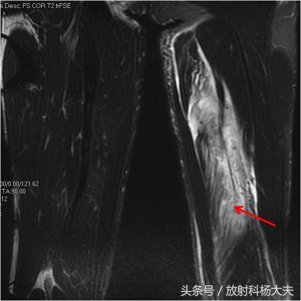 搬砖撞到小腿，拍片骨头没事，一周后腿肿，核磁发现问题