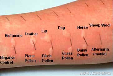 过敏原检测一般能不能查出过敏原,反复过敏怎么查过敏源