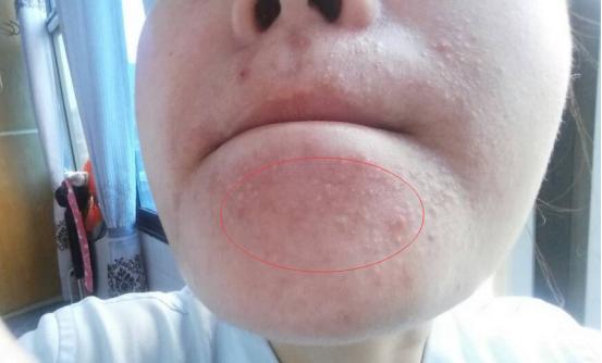 只有下巴反复长丘疹是什么原因,鼓起的硬痘痘