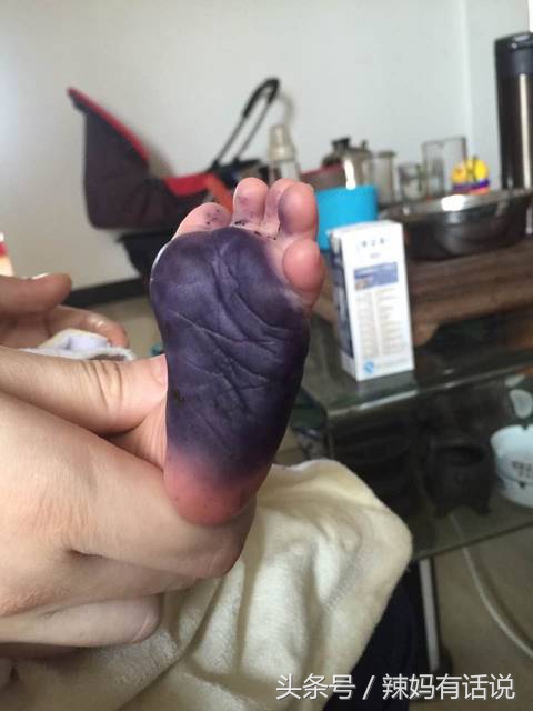 宝宝哭闹厉害!治疗宝宝肠绞痛的偏方,你敢用?