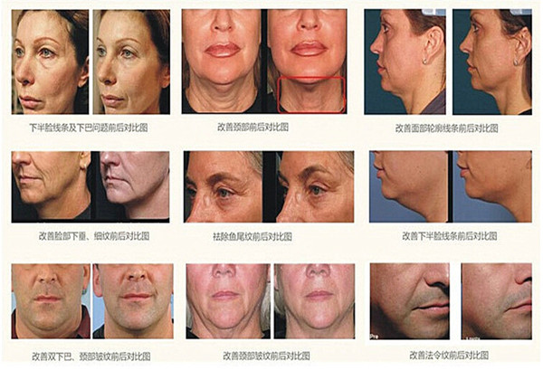 做过超声刀的真实体会,做超声刀后的真实效果