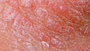 斑块银屑病症状和治疗,银屑病用药后斑块变大