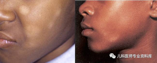 湿疹后有白斑是怎么回事,湿疹后白斑是白癜风