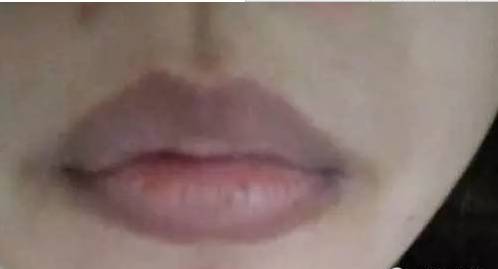 嘴唇上有几种颜色是什么病,嘴唇肿要警惕四种慢性病