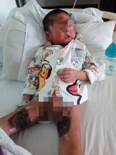 5岁儿童淋巴瘤治愈率,五岁孩子肠淋巴瘤严重吗