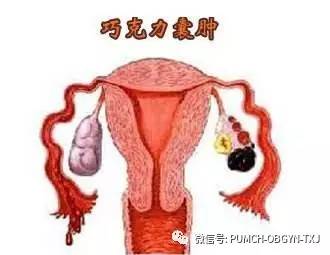 宫颈内膜异位症有哪些症状,子宫内膜异位症三联征