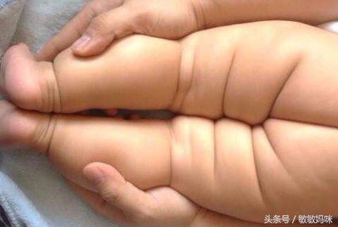 宝宝臀纹或大腿皮纹不对称怎么办,宝宝臀纹腿纹