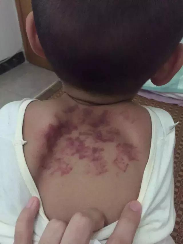 儿童急性支气管炎的最佳止咳方法,儿童咳嗽快速止咳小妙招支气管炎