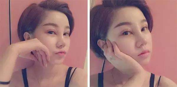 三段式假体隆鼻图片哪家好,进口隆鼻假体三段式