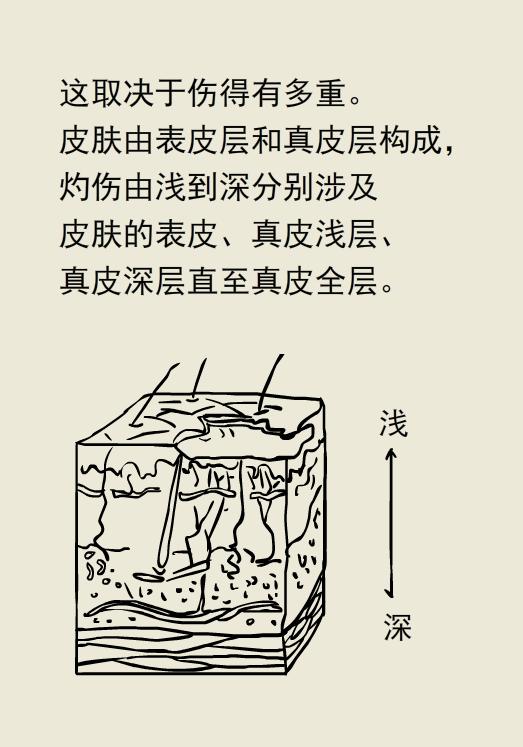 做饭时被热油烫伤怎么办,做饭被油烫伤了怎么办会留疤吗