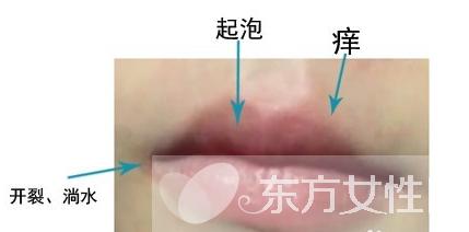 感冒嘴上起泡是什么原因,嘴上起泡是什么原因该怎么治疗