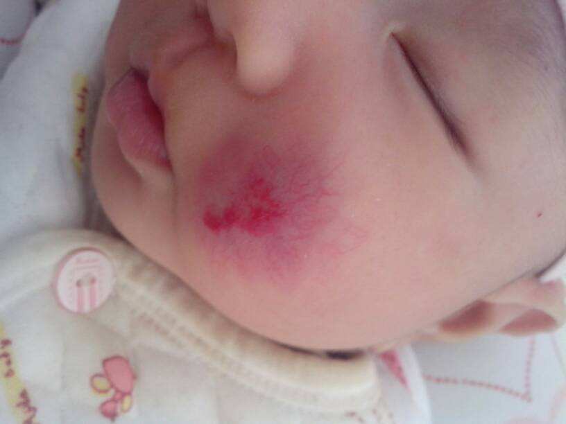 脸上有红色血丝怎么去除,新生儿脸上有红色血丝