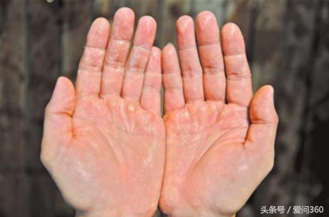 手指脱皮起皱是肾虚吗,手起皱脱皮怎么治
