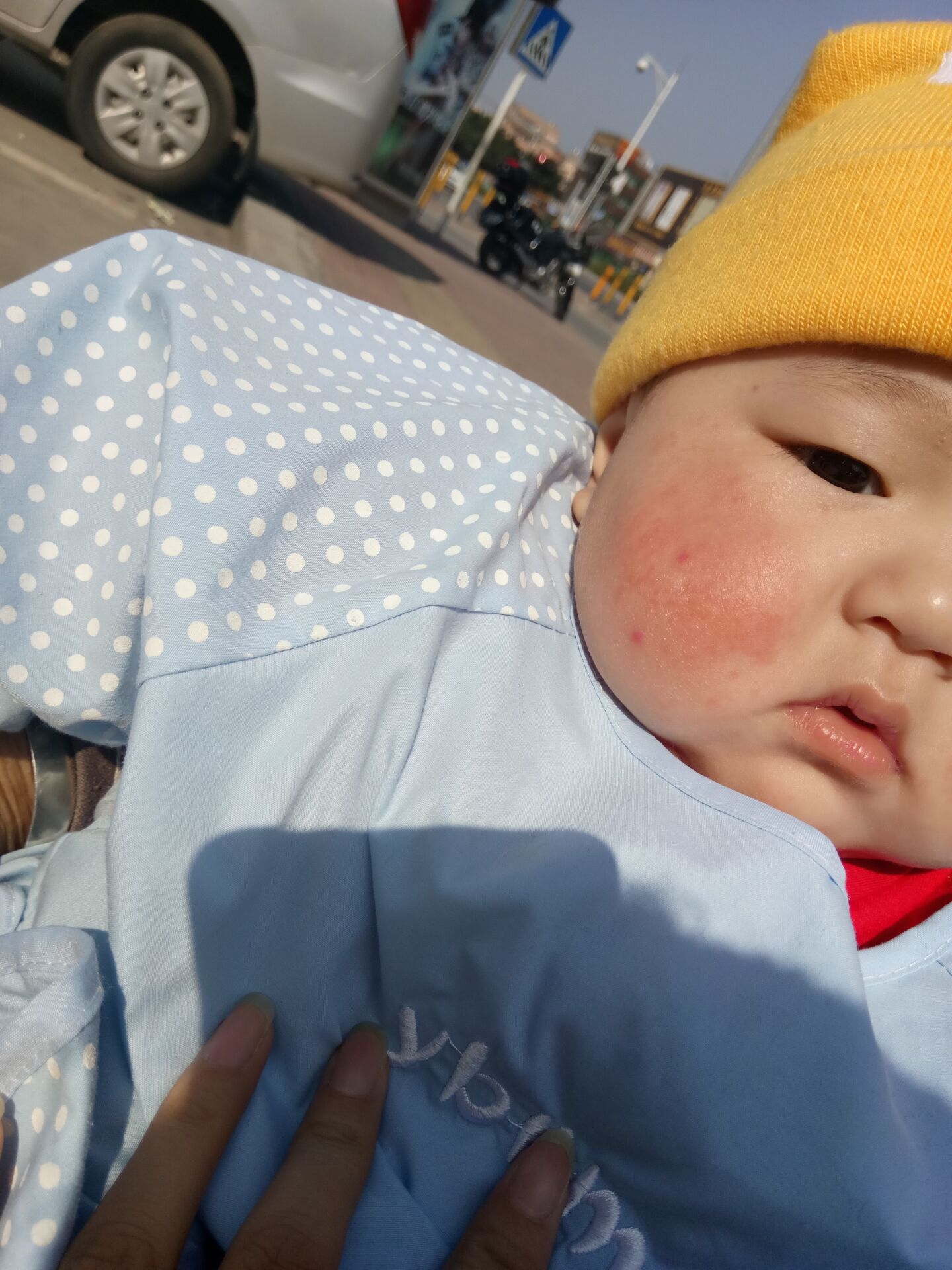 湿疹怎么办最有效的方法,湿疹怎么办知乎