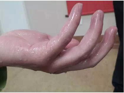 手足经常出汗怎么样根治,手足出汗怎么回事