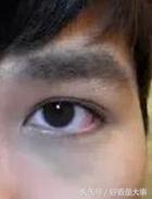黑眼圈真的就没办法了吗,黑眼圈真的没办法了吗