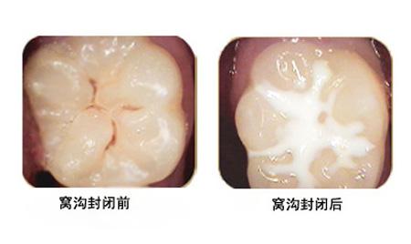 小洞不补大洞难补什么意思,5岁男童龋齿一个小洞处理办法