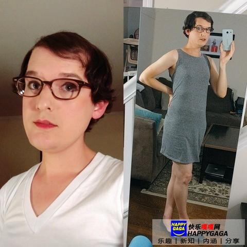 雌激素治脱发,雄性激素脱发补充雌性激素有用吗