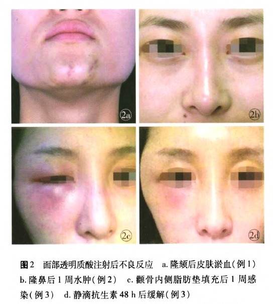 微整形安全还是危险,微整形值得做吗