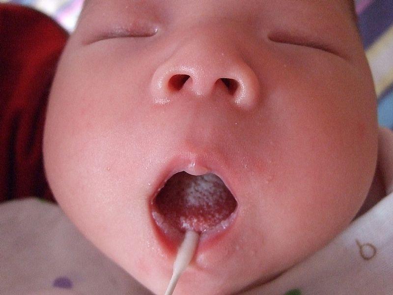 妈妈锦囊（28）：鹅口疮的预防和治疗