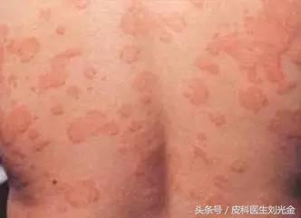 孕妇得了*麻疹荨**，他竟敢用这种药？