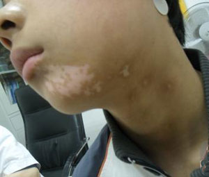 白癜风吃啥有助于治疗,白癜风应该注意什么饮食