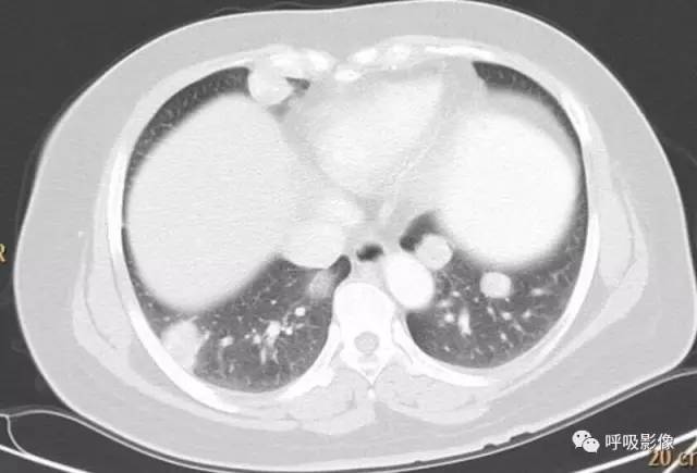 绒毛膜癌转移到脑,绒毛膜癌肺转移