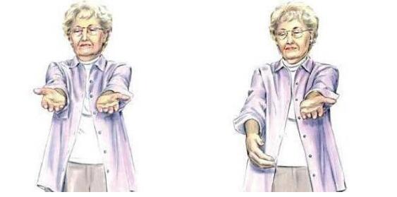 脑血栓最怕三个动作,有了脑血栓前兆该怎样做