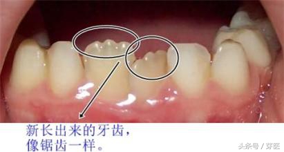 刚换牙的宝宝门牙长歪怎么办,宝宝门牙为什么长的象锯齿状