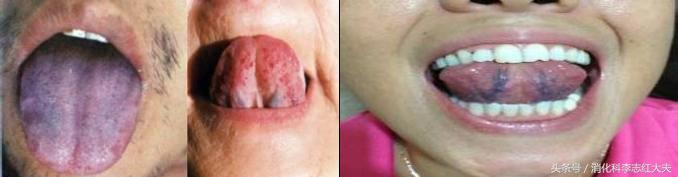 反流食管炎加萎缩性胃炎中医治疗,反流性食管炎中医把脉能看出来吗