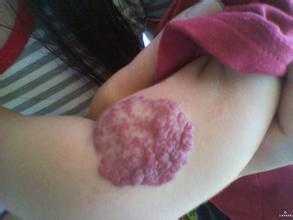 草莓状血管瘤打一次针多少钱,草莓状血管瘤治疗可以报销吗