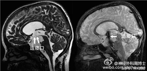 颅内蛛网膜囊肿有症状不及时治疗,颅内多发蛛网膜囊肿怎么治