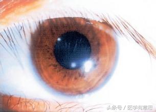 眼睛下角膜破皮,起床眼睛被眼屎糊住咋回事