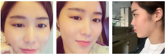 玻尿酸丰唇即刻效果,玻尿酸丰唇有几种唇型