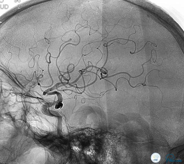支架辅助弹簧圈栓塞治疗狭窄伴复杂动脉瘤