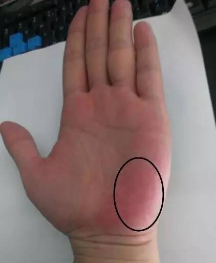 手掌发红用什么药膏,手掌脱皮严重还发红