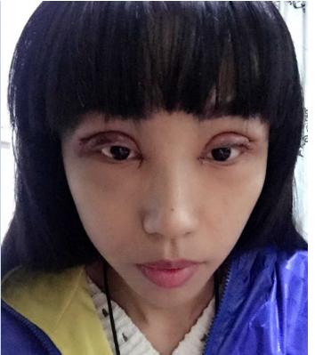 双眼皮割得太宽了怎么办,眼骨低割不了太宽的双眼皮