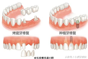 烤瓷牙与种植牙的区别(yarbeija科普)