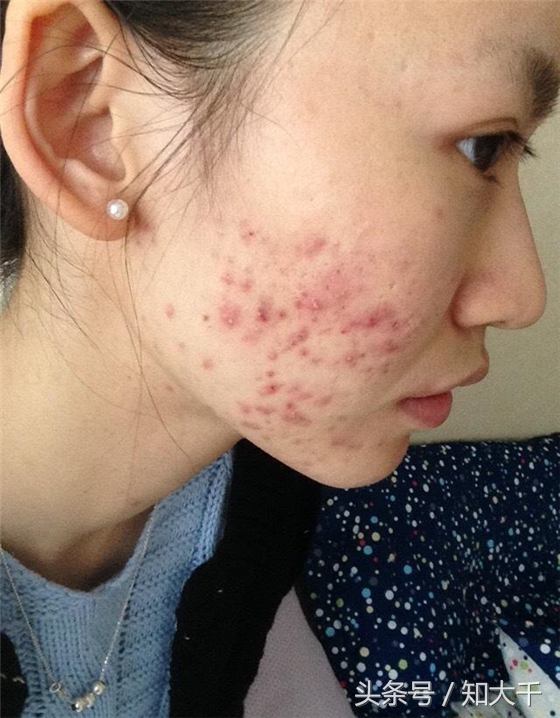 十几年的祛痘印公认最好的方法,祛痘印排行榜第一名最良心测评