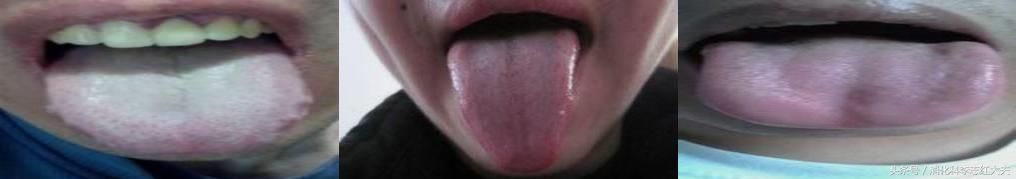 反流食管炎加萎缩性胃炎中医治疗,反流性食管炎中医把脉能看出来吗