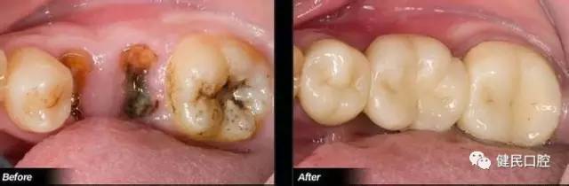 蛀牙根管治疗视频,蛀牙应该怎么治疗最好