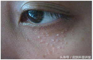 眼周很多小颗粒怎么办,眼周起斑点是什么原因