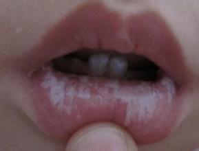 一岁宝宝嘴烂最快治疗方法,1岁11个月宝宝嘴烂了